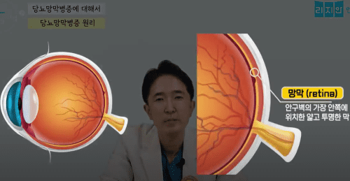 당뇨병 환자 필독! 당뇨망막병증의 모든 것