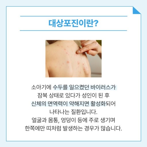 대상포진