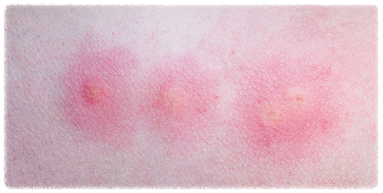 빈대증상-퇴치약