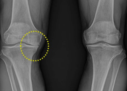 글루코사민 효능, 부작용, 복용법, 추천 상품