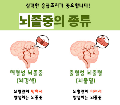 뇌졸중의 이해와 치료, 예방 전략 관련 이미지