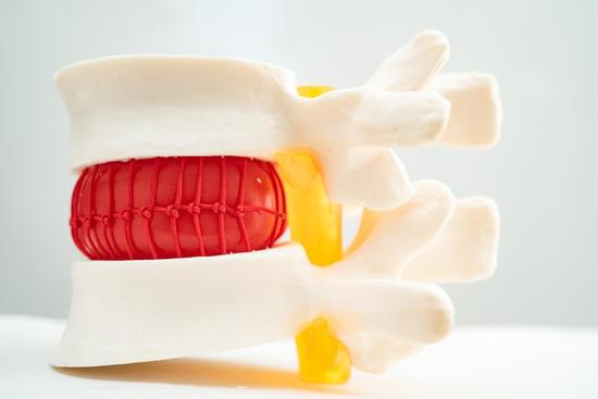 허리 디스크(추간판 탈출증, Herniated Disc): 원인, 증상, 치료법 및 예방법