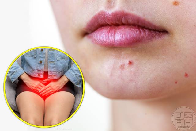갑자기 여드름 나는 이유 성인여드름 호르몬 생리