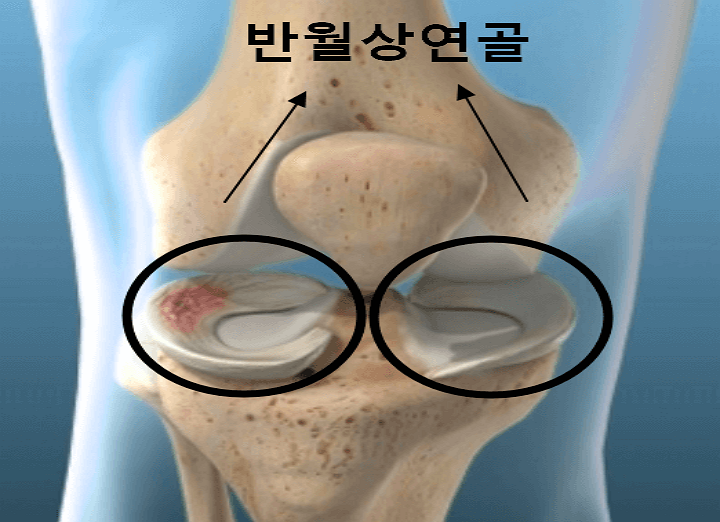 반월상 연골 위치