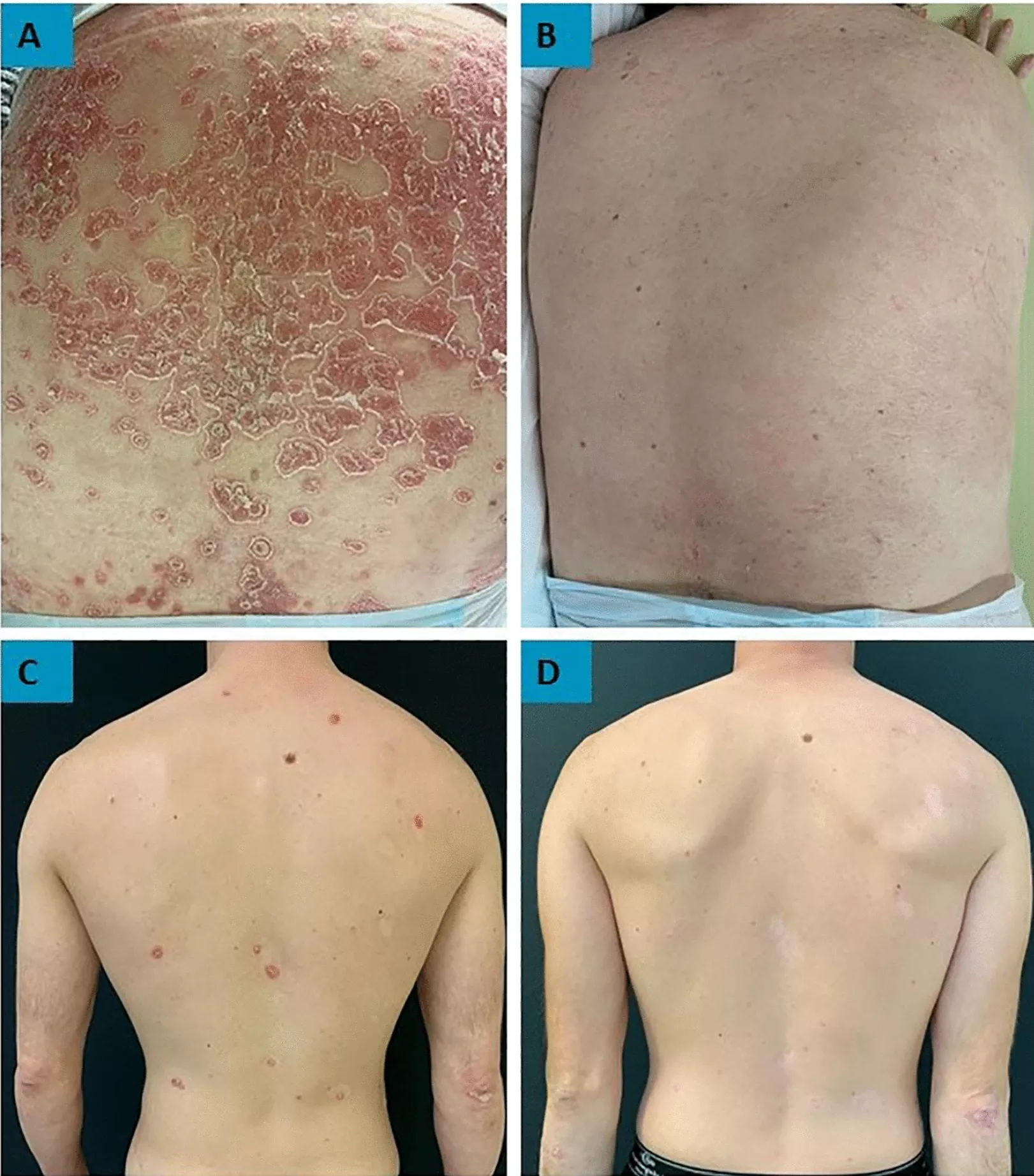 DMF-치료-받기-전-후