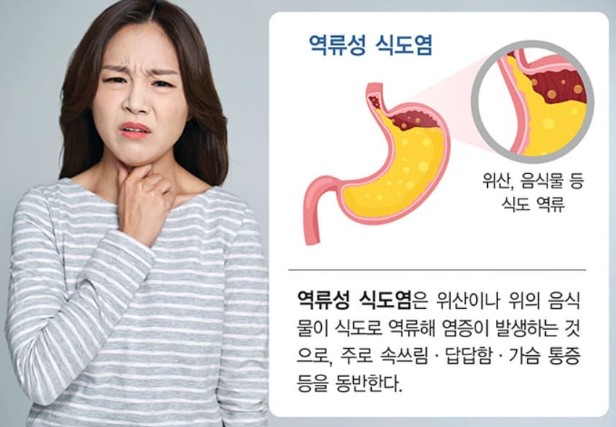 역류성 식도염