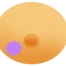 신경섬유종 초기 증상, 혹시 나도? 놓치면 안 되는 신호