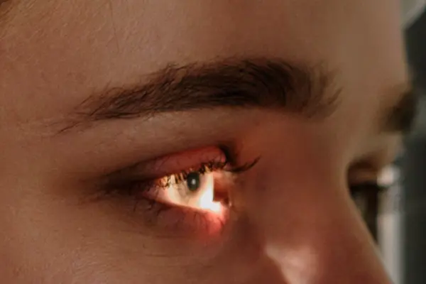 비문증(날파리증)