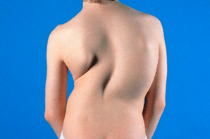 이사진은 춪증의 척추측만증(척추 만곡)이 있는 청소년기 소녀를 보여줍니다