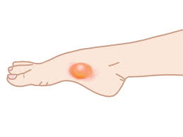 화상 물집 치료방법