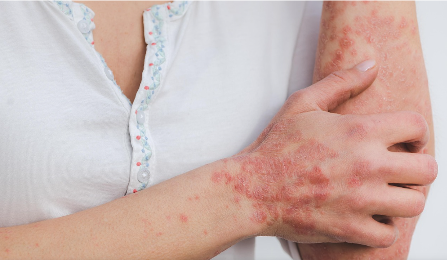 만성 피부질환, 건선의 모든 것