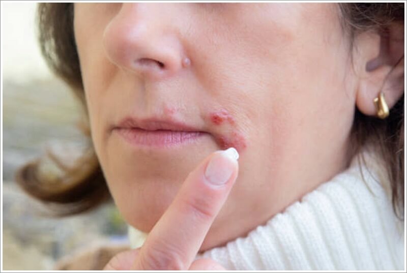 입술 주위 붉어짐-작은 물집