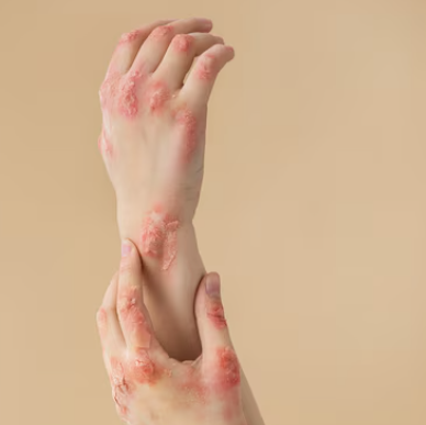 대상포진 초기증상 17