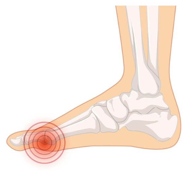 무지외반증 통증 위치