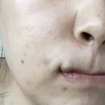 생리 전 뾰루지 폭발 원인과 해결법 7가지 생리 전후 뾰루지 발생 이유 완벽 분석_4