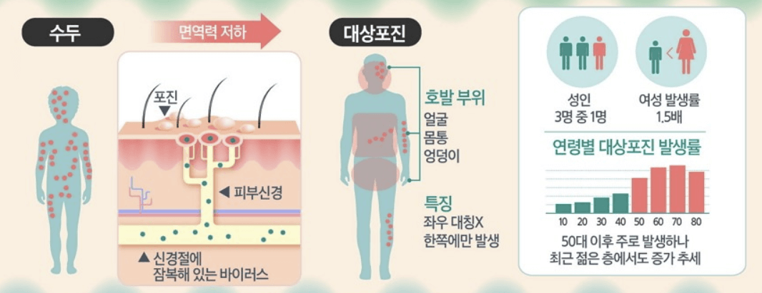 대상포진