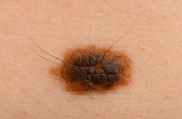 피부의 점에서 길고 억센 털이 자라도록 돕는 단백질을 발견