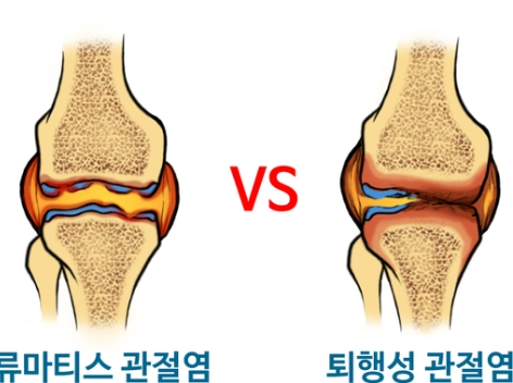 50대 관절 통증&amp;#44; 원인과 대처법
