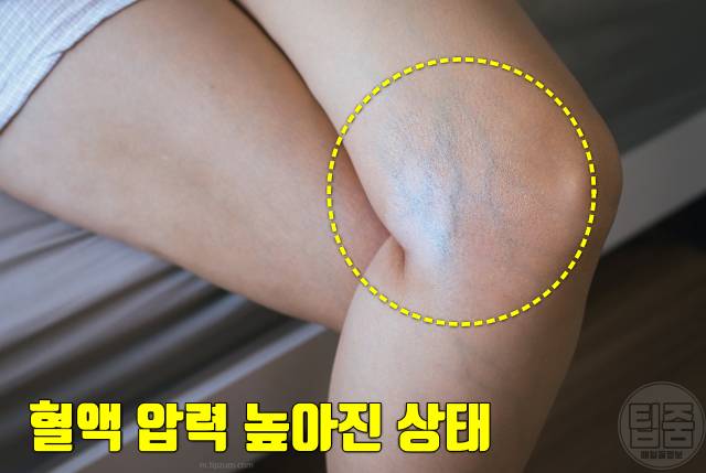 종아리 혈관 튀어나옴 하지정맥류 증상 예방 다리꼬기