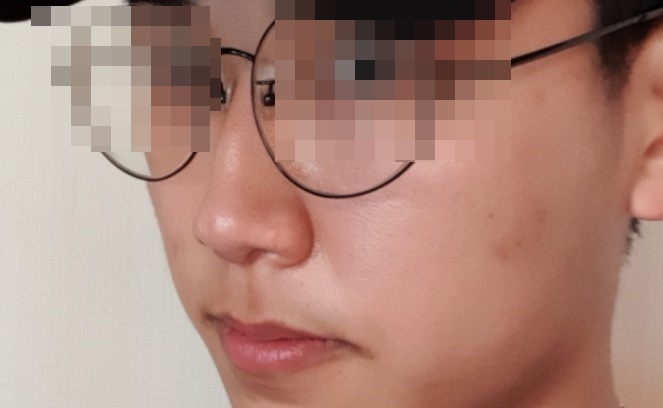 비중격 만곡증 수술 후기