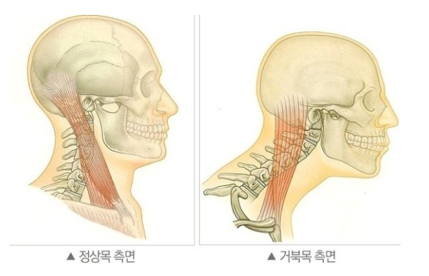 정상목 거북목 비교