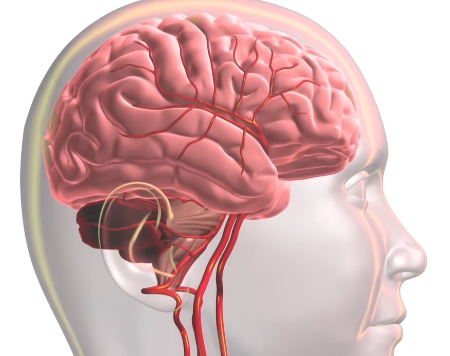 뇌경색 전조증상