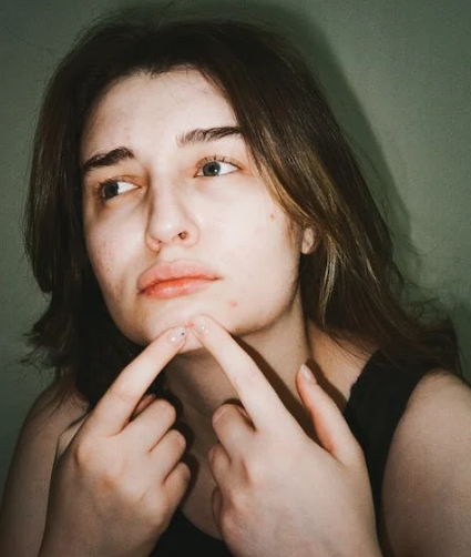 자궁근종-여드름