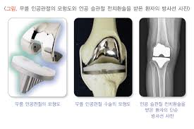 관절경수술 후 물리치료 운동 가이드
