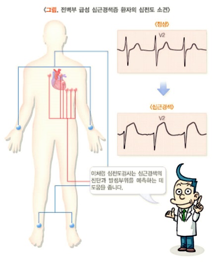 심근경색이미지