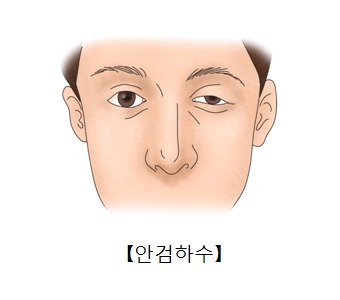 뇌동맥류 코일색전술