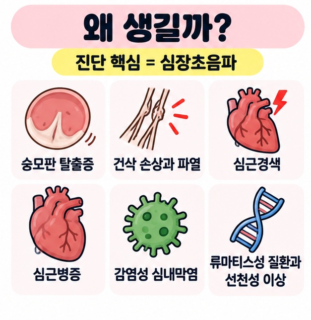 승모판 탈출증, 건삭 파열, 심근경색, 심근병증, 심내막염 등 승모판 폐쇄부전증의 주요 원인을 정리한 카드