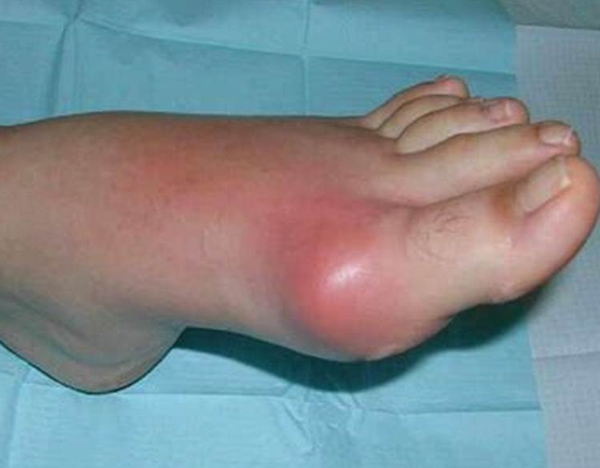 통풍 초기증상3