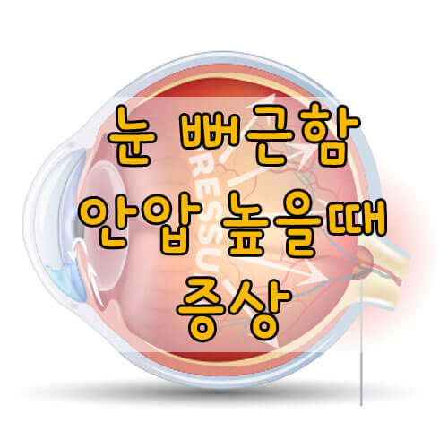 안압이 높을때 증상, 눈 무거운 느낌, 뻐근함 이유와 눈 피로 푸는법! 꼭 병원에 가야 하는 경우는?