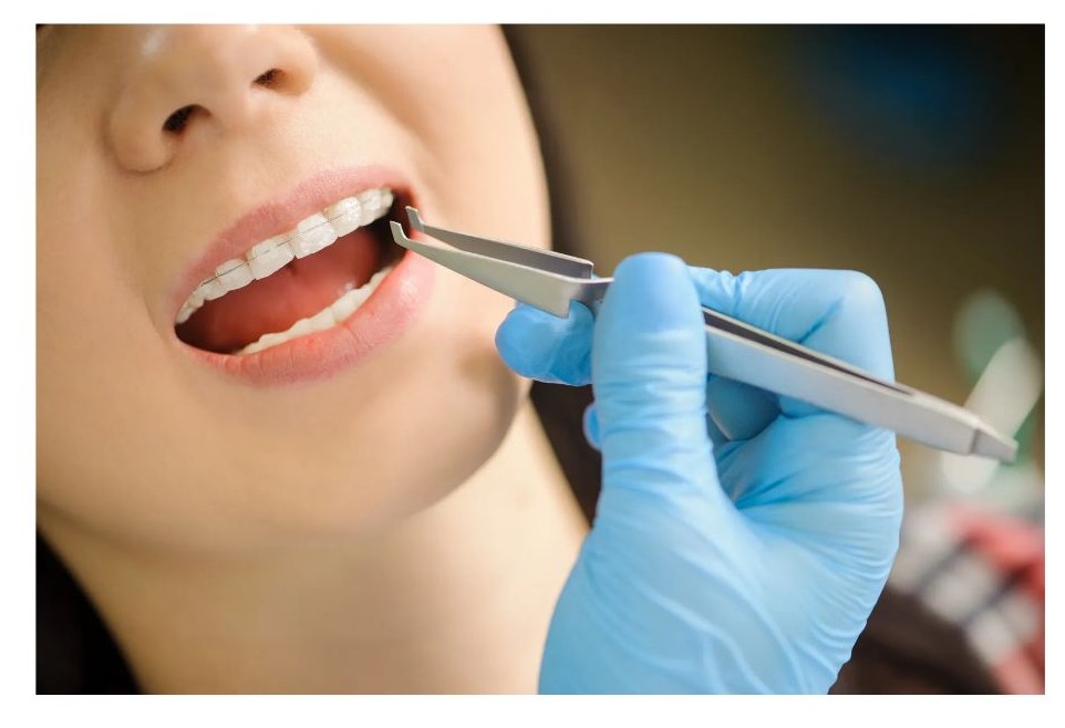 여자 치아 이미지