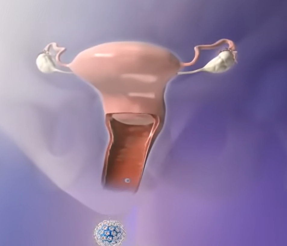 hpv 바이러스 원인