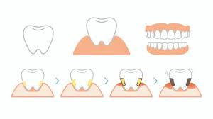 잇몸 염증 치료제 베스트 5