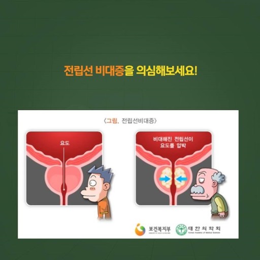 방광을 압박하고 요도를 압박할 수 있는 전립선 비대증