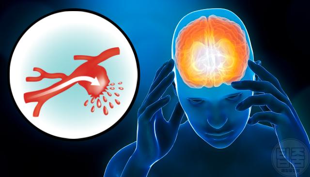 뇌동맥류 증상 구토 눈부심