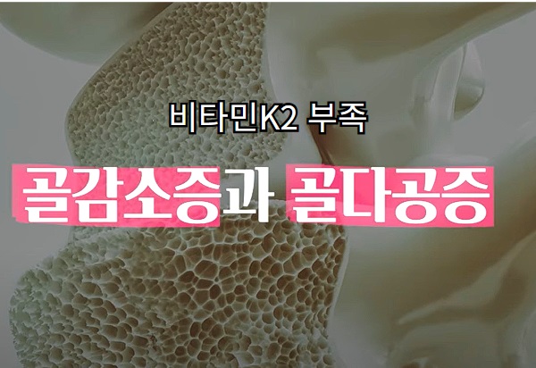 비타민 K2 부족 현상 - 골다공증 모습