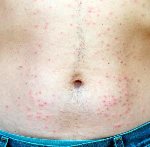 모낭염 원인과 치료방법