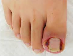 내성발톱 자가치료