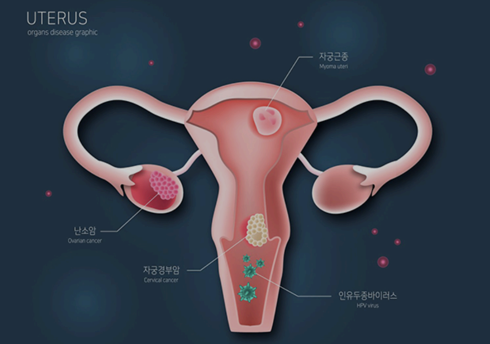 성관계 후 질출혈