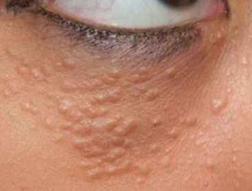 한관종(syringoma)