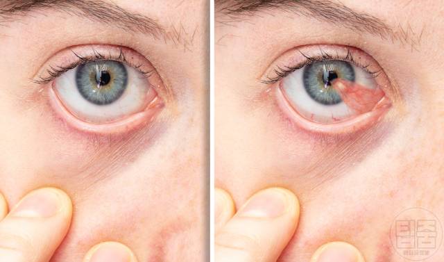 눈 따갑고 눈물 안구건조증 해결 눈뻑뻑함 이물감 눈건조증 원인