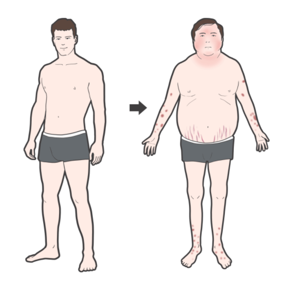 스테로이드 부작용