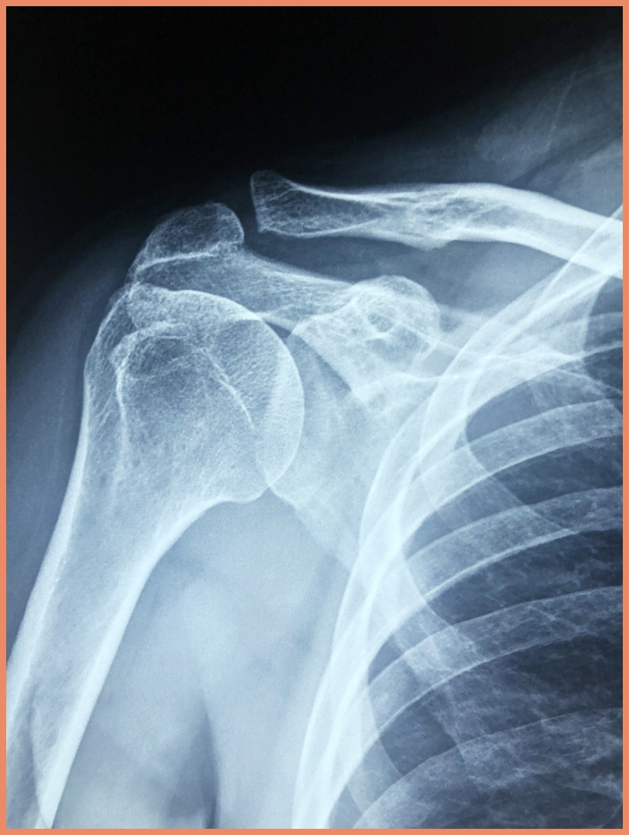 어깨충돌증후군이란? 발병 원인과 증상 총정리!