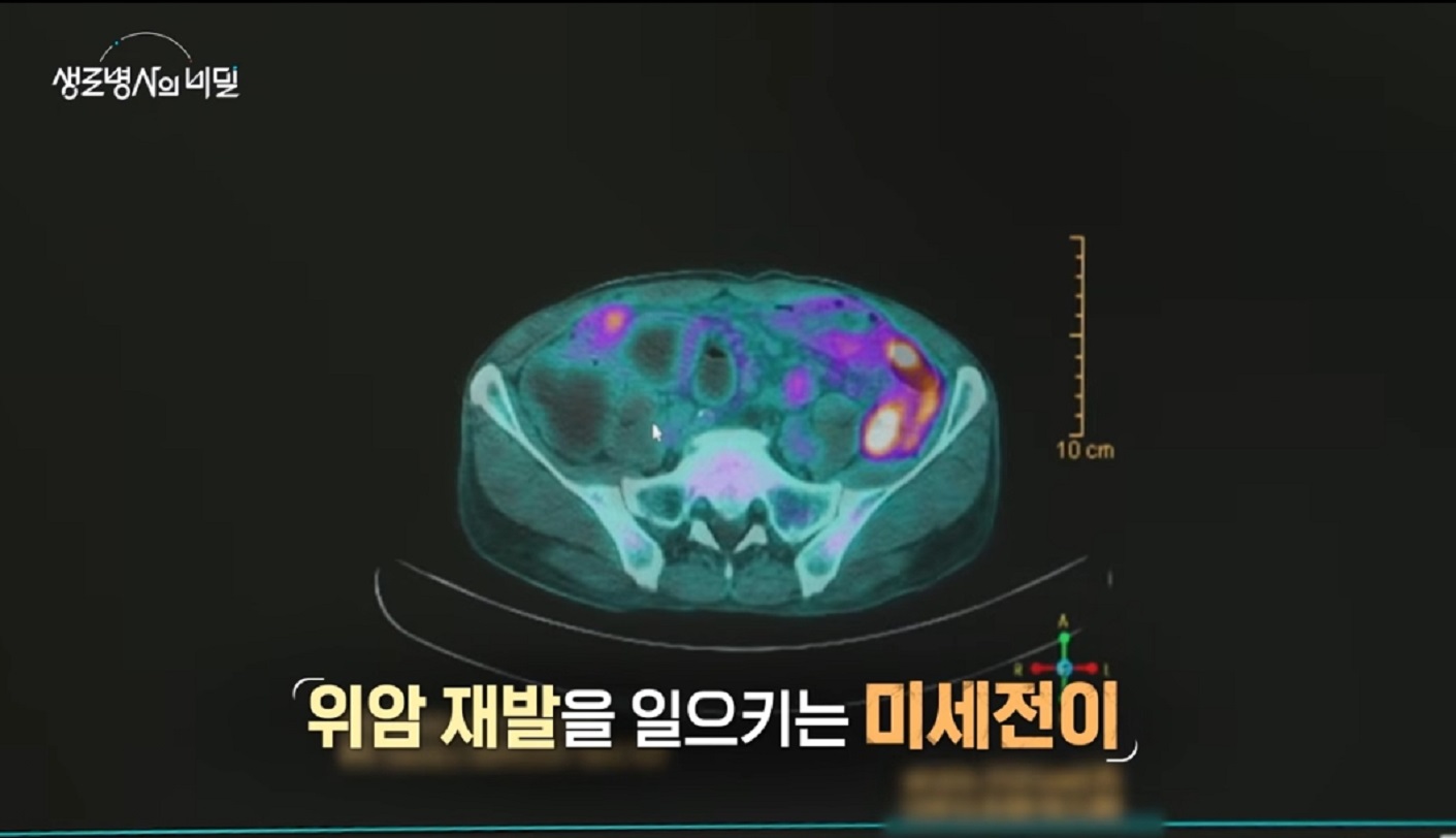 위암보고서-재발과-전이