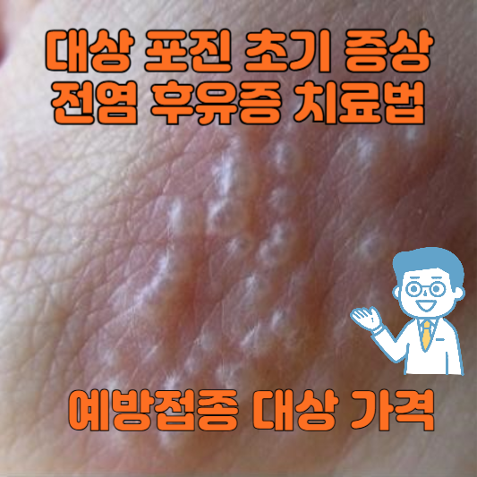 대상포진 증상 치료방법 예방접종