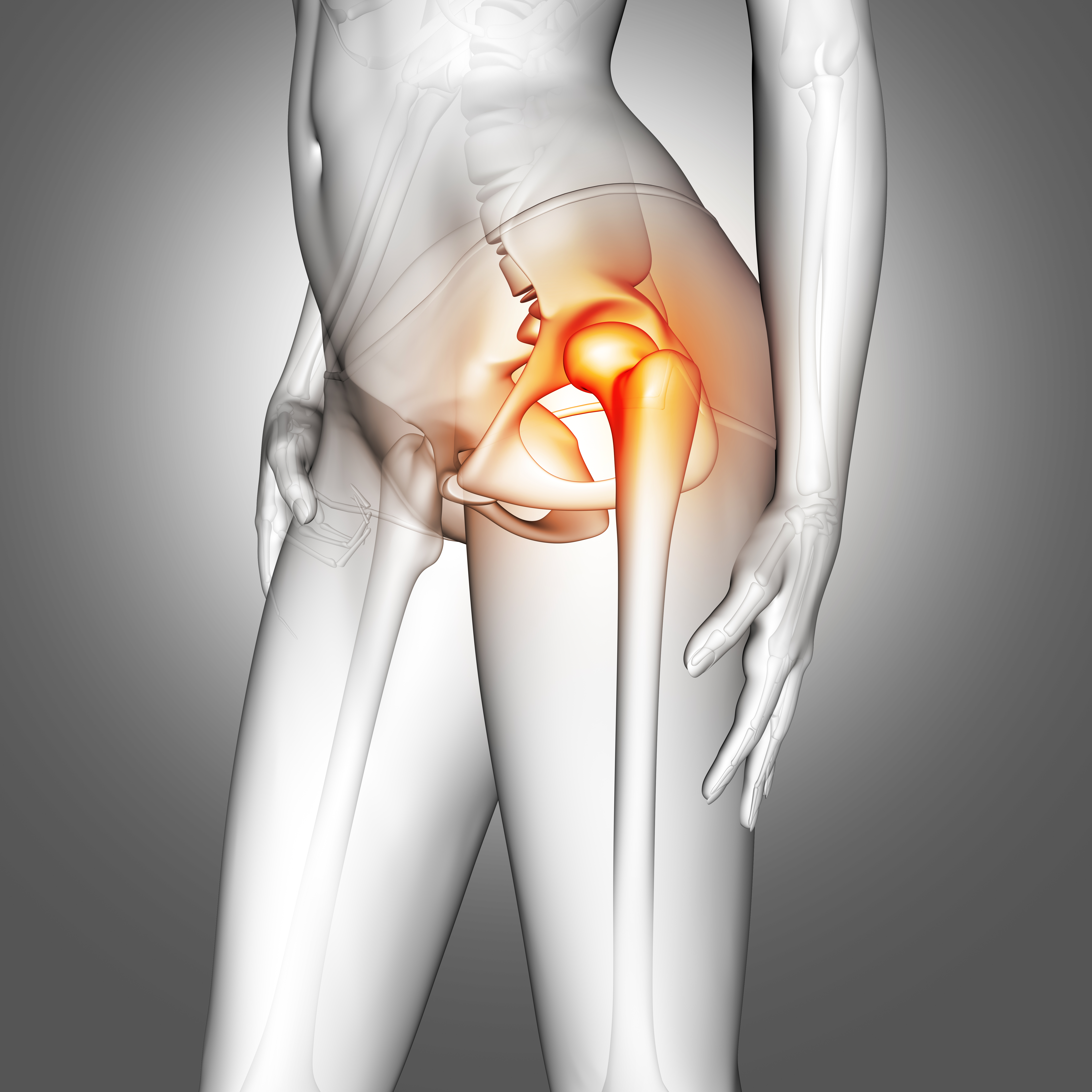 Total Hip Replacement(THR) 
 고관절 인공관절 수술