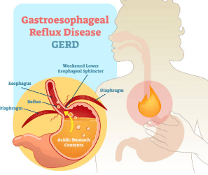 역류성 식도염 증상 10가지, 자연치료 방법